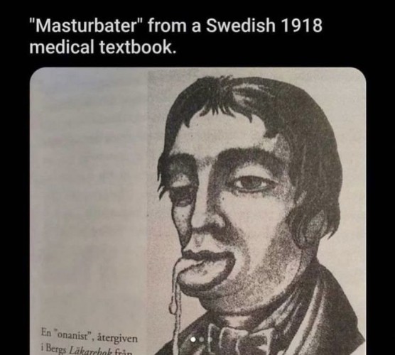 Caption: "masturbater" from a Swedish 1918 medical textbook.

Black and white drawing of a drooling moron wearing a bow tie